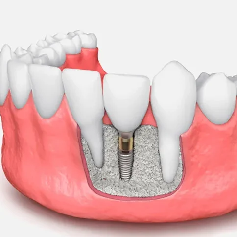 rehabilitacion osea tossal dental valencia