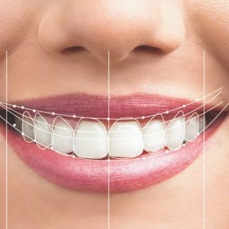 Sonrisa brillante con dientes alineados y un diseño de ortodoncia visible.
