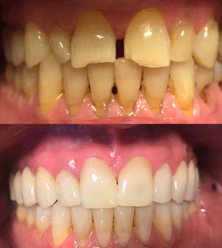 Comparativa de dientes antes y después de un tratamiento dental.