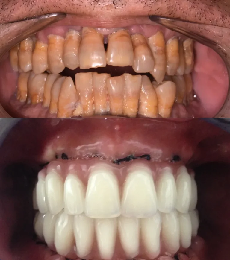 Foto de resultados carga inmediata implantes dentales