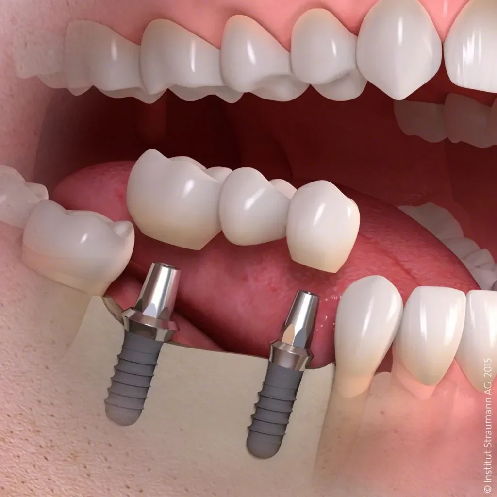 imagen de puentes dentales sobre implante