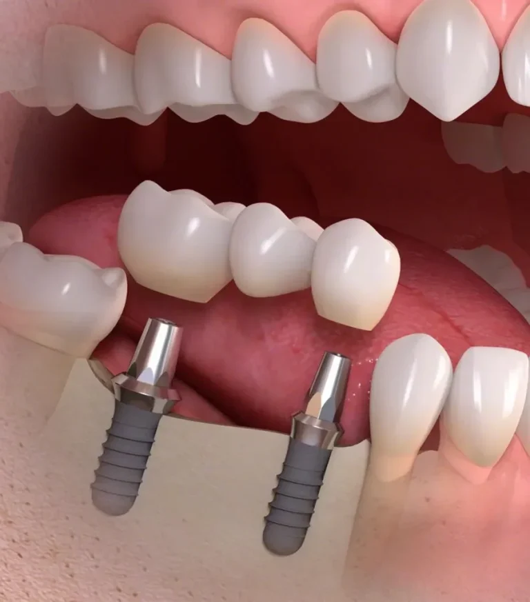 implante dental tossal dental