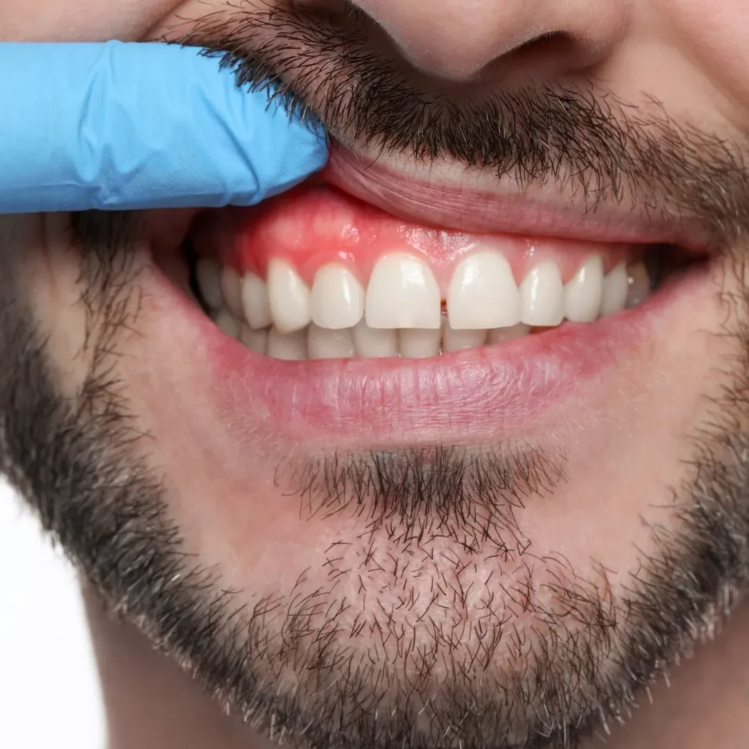 Dentista examina encías inflamadas de un hombre con sonrisa amplia y dientes blancos.