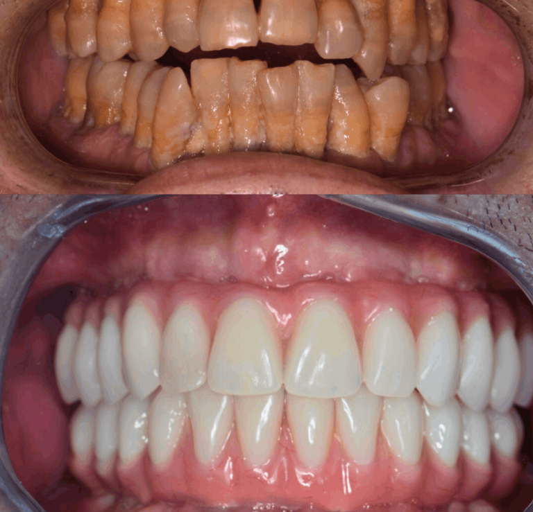 Comparación de dientes antes y después de tratamiento dental, mostrando mejoras visibles.