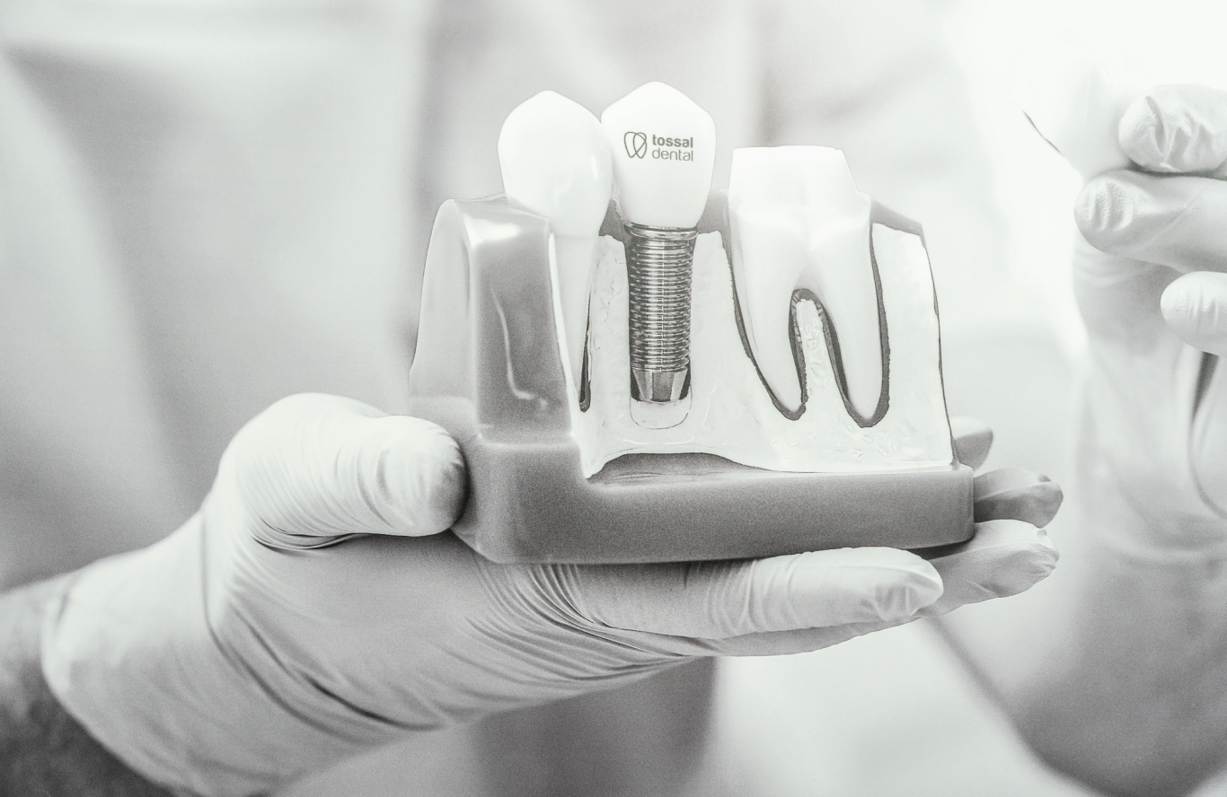 Imagen de implantes tossal dental valencia