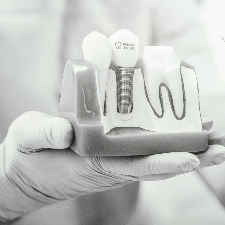 Imagen implantes dentales tossal dental valencia