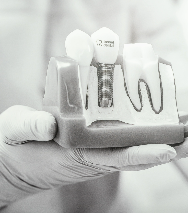 Imagen de implante dental tossal dental