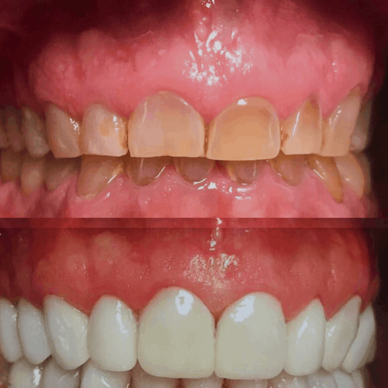 Comparación de dientes antes y después de un tratamiento dental.