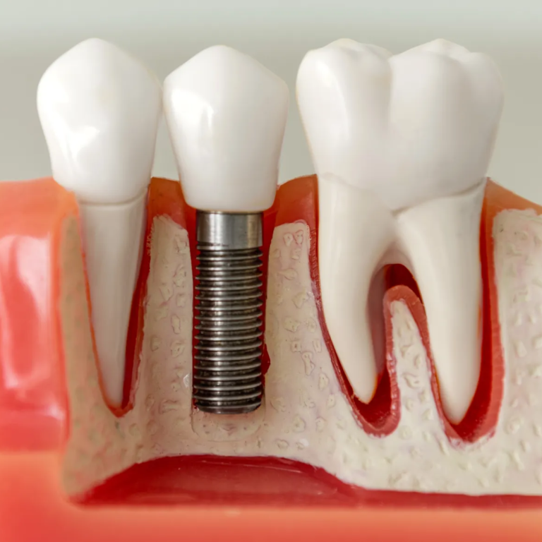 Imagen dental tossal dental  valencia